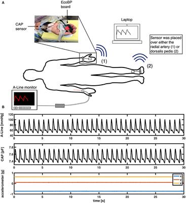 Clinical Validation of a Soft Wireless Continuous Blood Pressure Sensor During Surgery
